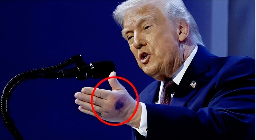 特朗普藏不住了，刚在公开场合露脸，左手背一块青黑瘀青直接抢镜，这可不是第一次了，