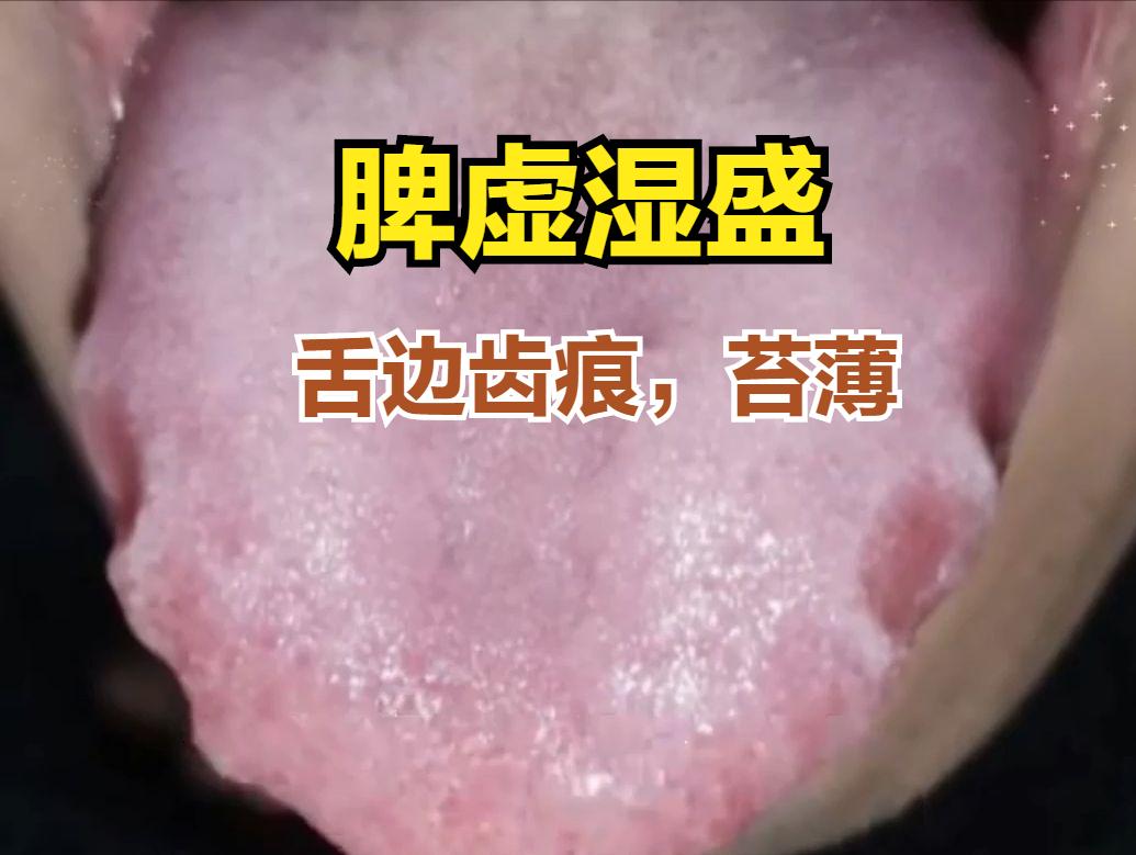 脾湿也分三种，对症调理才是王道！

①脾虚湿盛——舌质淡，舌边有齿痕，舌苔白
因