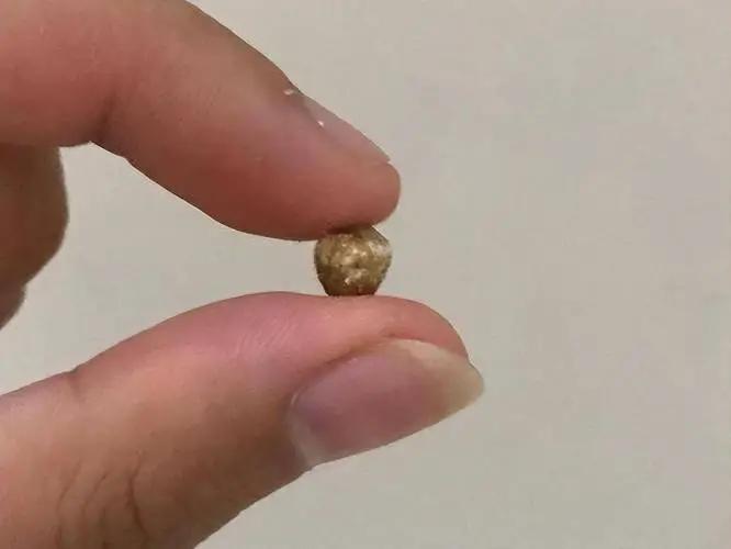 结石是“吃”出来的？医生无奈摇头：不想结石越变越大，远离这三种食物


“医生，