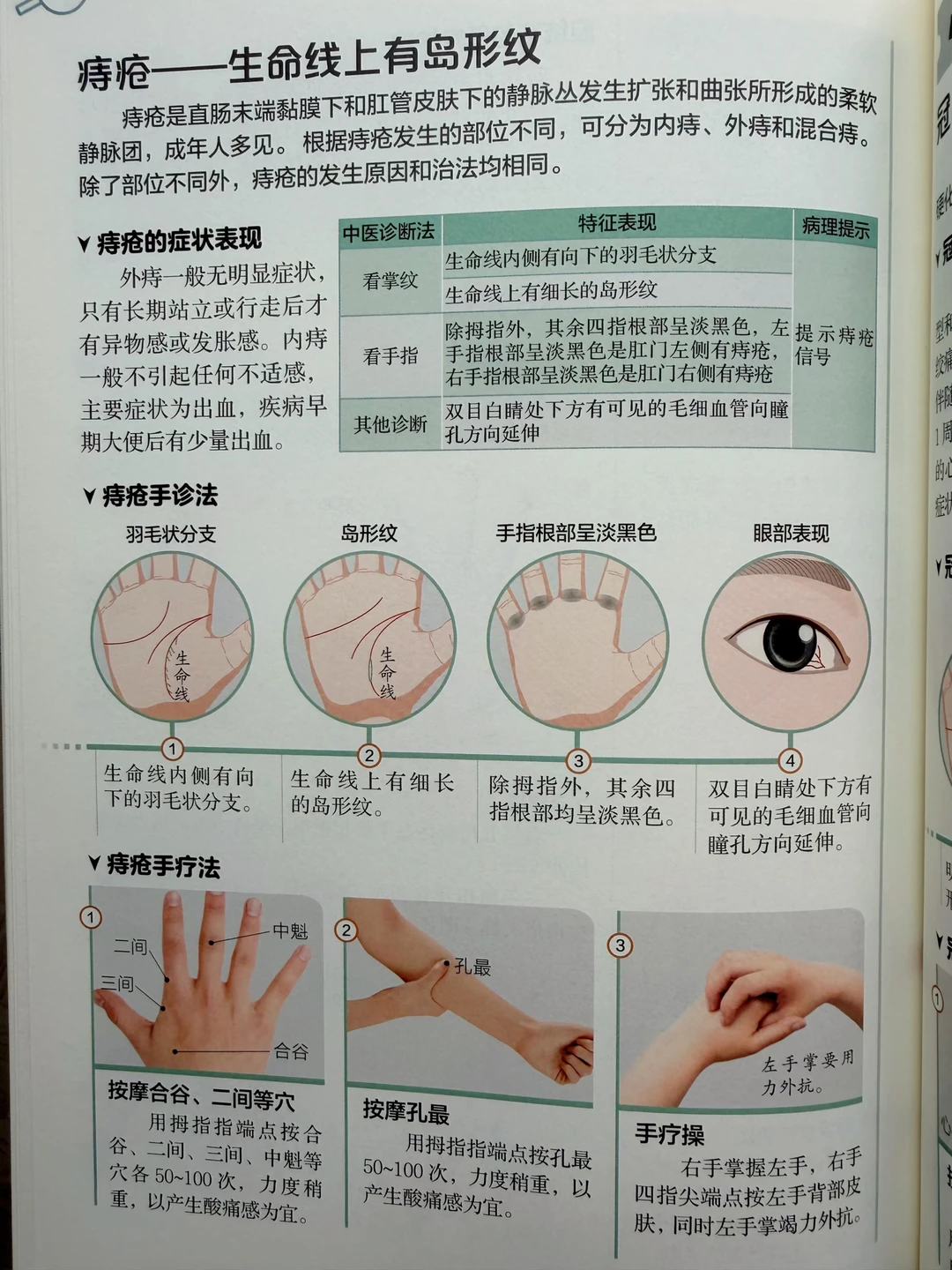痔疮