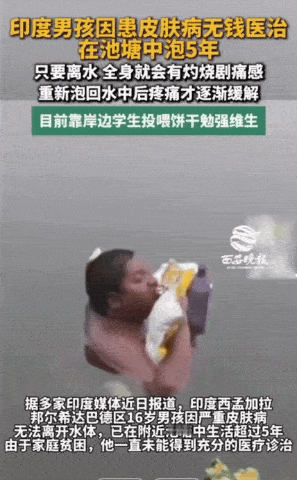 16岁少年困在池塘5年：离水就全身灼烧剧痛，没钱治病只能泡冷水续命
 
你能想象