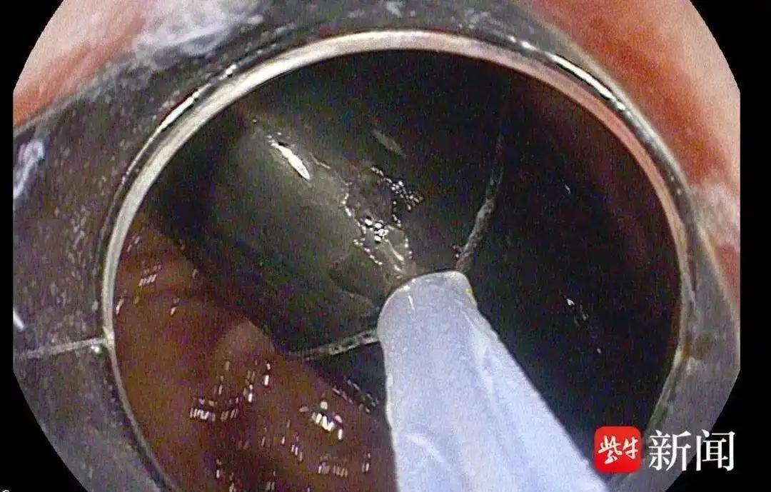 强胃王！这你一定是第一次听说。 
你敢信吗？打火机在胃里待了整整 7 年！ 
