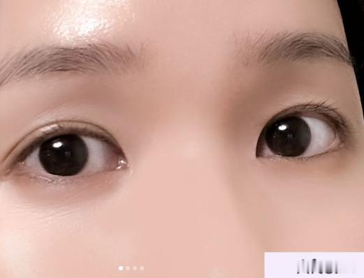 韩国双眼皮修复里面有几点想写下，是我接触过大量修复之后的真实感受：首先，眼距近的