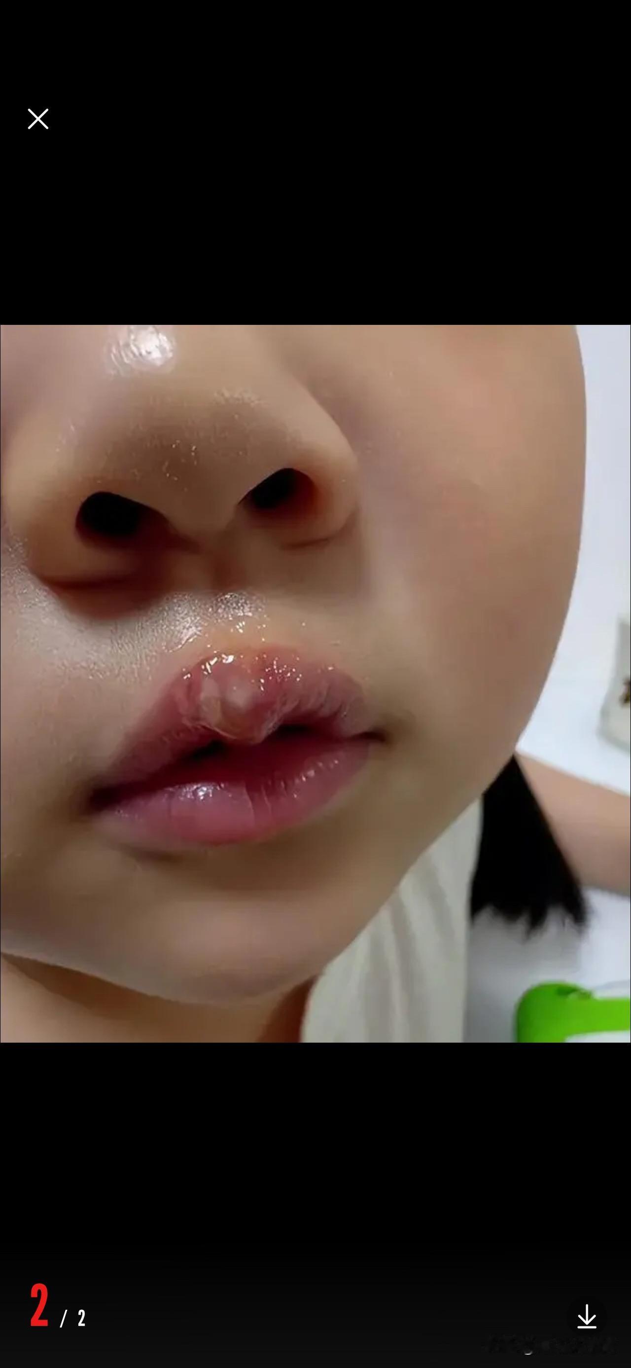 幼儿园4､5岁的孩子讲话，陈老师生气惩罚，
疑用热熔枪烫坏孩子们的嘴唇、掌心，