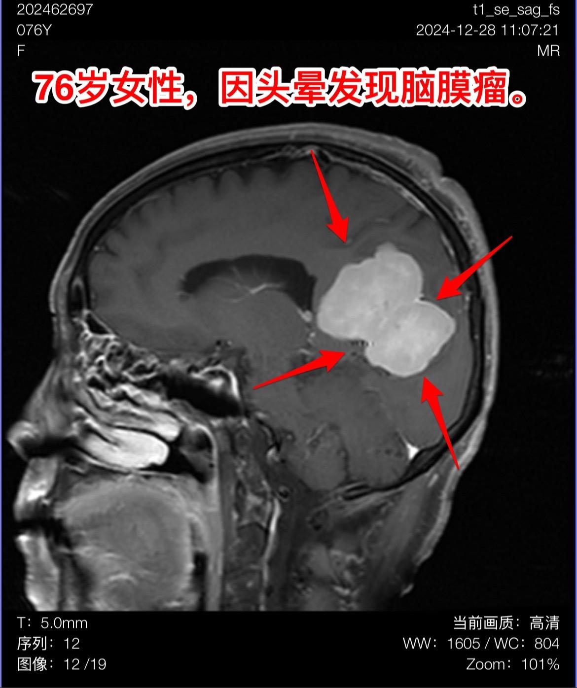 76岁女性，发现脑肿瘤需要作手术吗？山东省菏泽市的76岁女性，因头晕症...