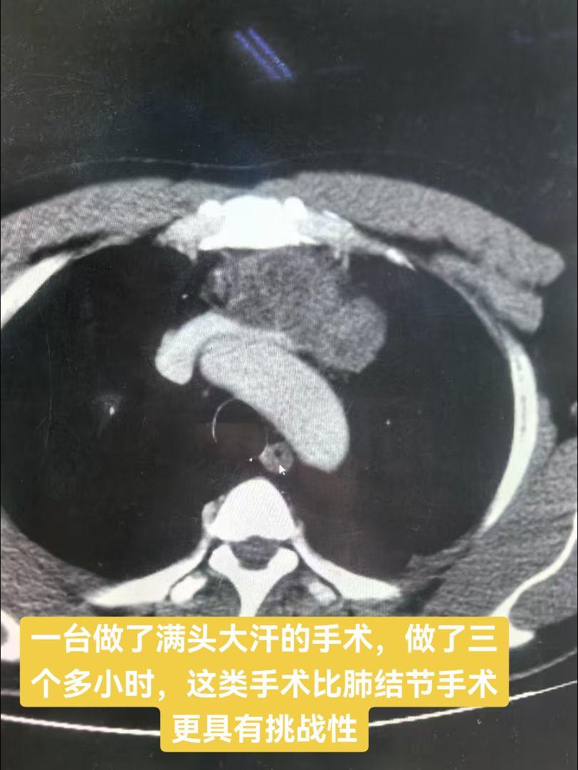 巨大纵膈肿瘤，侵犯无名静脉，主动脉弓及心包。手术切除部分心包，阻断无名...