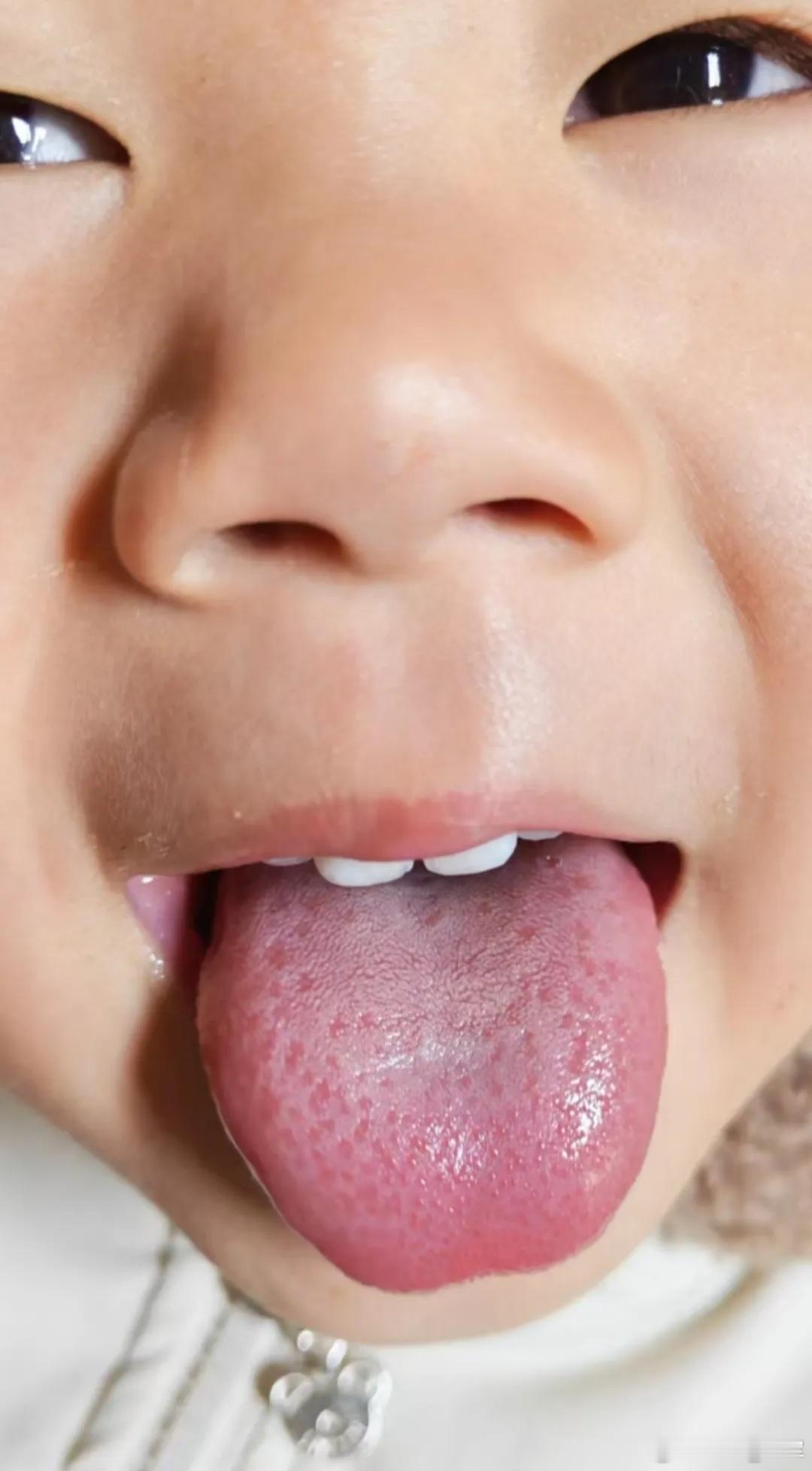 小儿体质的核心——稚阳之体🙋易积易热无内热不生外感👅辨象、方便直接用在孩子身