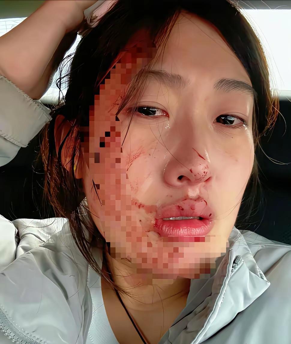 不可理喻！
23岁护士被两拳打成重伤，这哪是护娃，分明是施暴！河北秦皇岛这场扎针