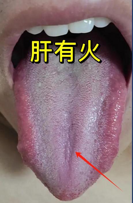 大家好，我是中医陈大夫！生活里不少人动不动就急躁易怒，还总被头痛头晕、眼睛红肿、