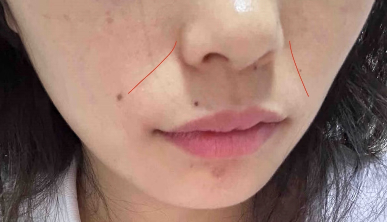 这也是一种典型的法令纹，你身边又是否有这样的人呢？将会在一对一面相思维学习里面分
