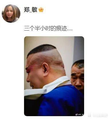 郑敏晒郭德纲后台照，戏妆卸后头皮现深痕，刀刻般印记见证舞台背后的艰辛与执着。 ​