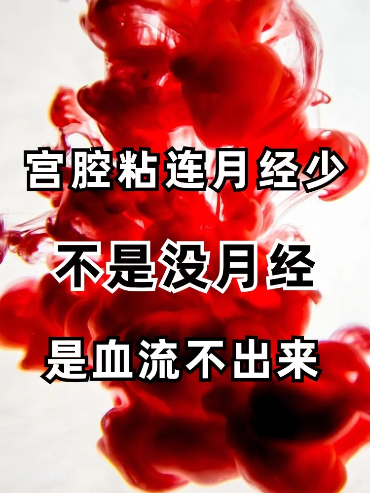 宫腔粘连月经量少，是🩸被堵住了