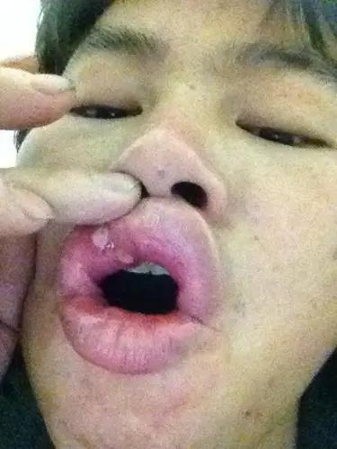 口腔溃疡上火不简单
口腔溃疡的病因和大部分人想的差不多，罪魁祸首是“火”，但这个