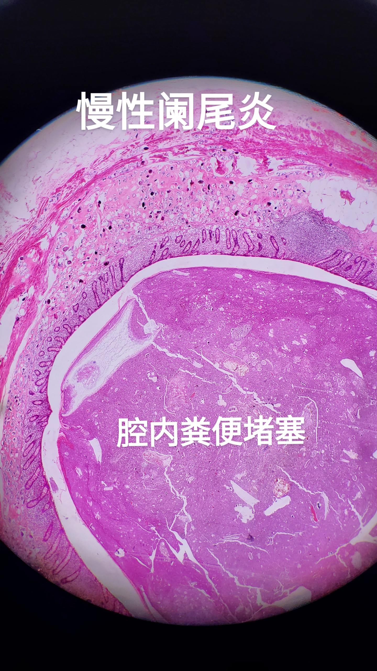 慢性阑尾炎 慢性血吸虫病