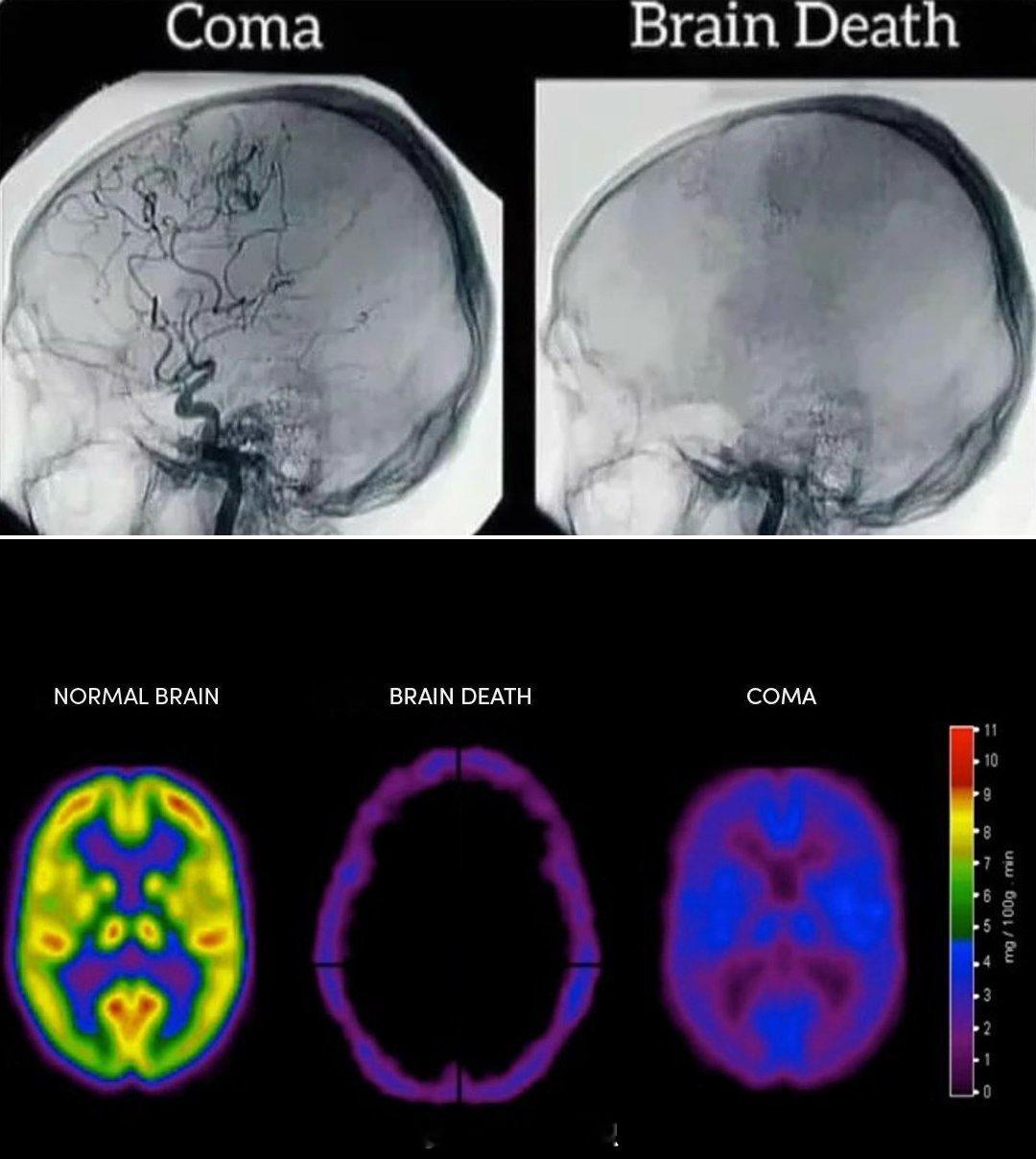 血管造影显示昏迷与脑死亡的差异对比。 ​​​