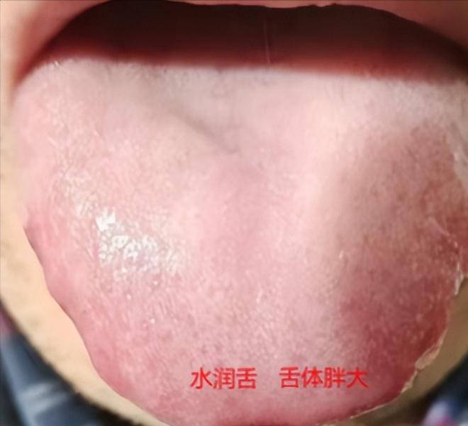 白腻苔 + 水润舌 = 虚不受补？3 种舌象辨清楚，进补不踩坑

舌象一：舌体胖