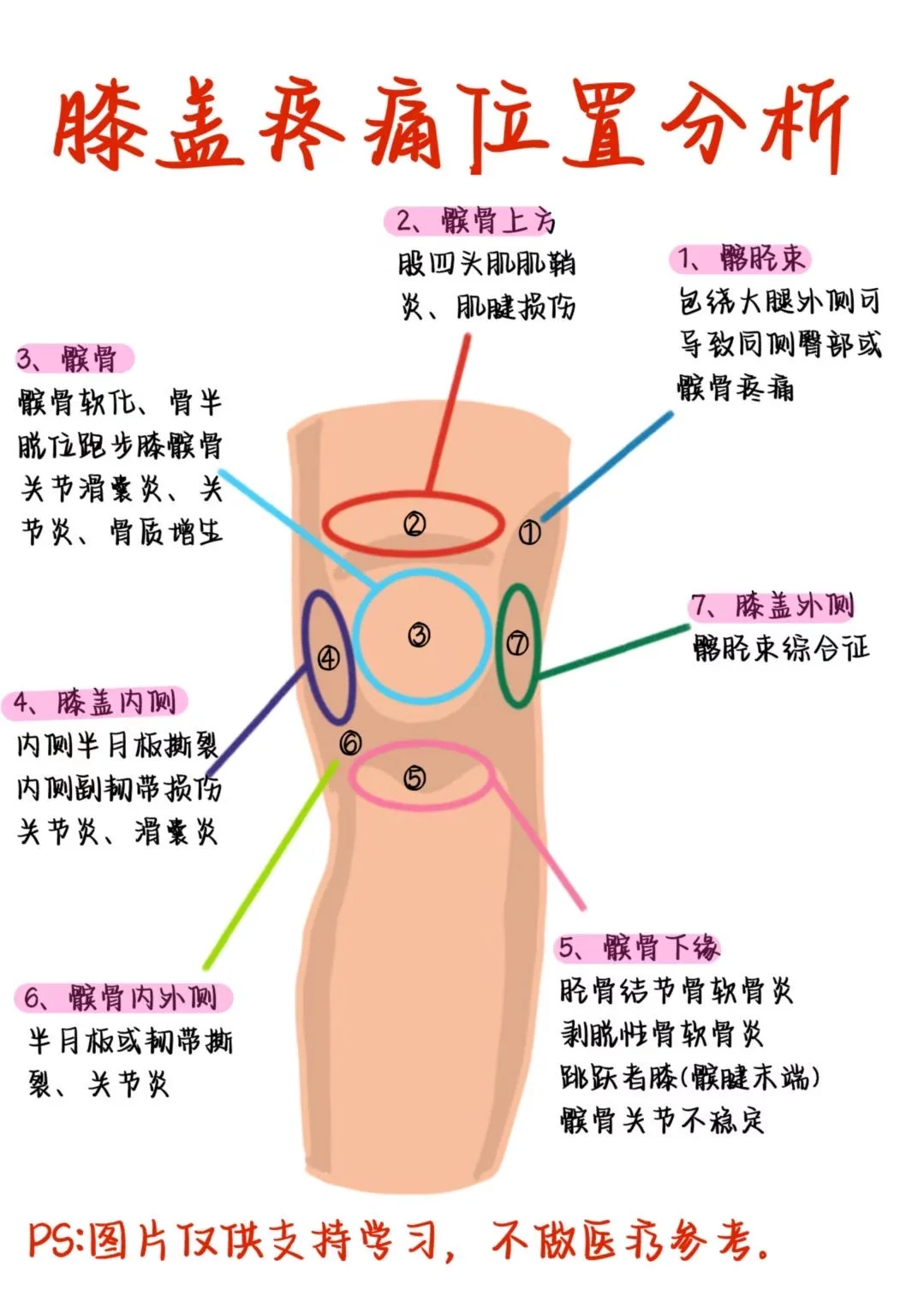 医学生笔记——膝盖疼痛位置分析
