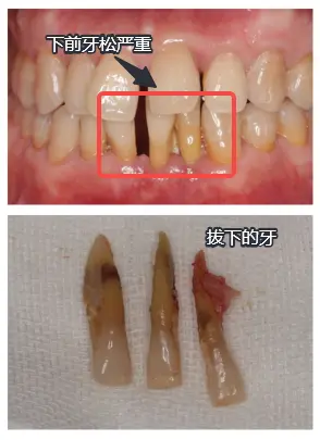 这么尖的牙根你见过吗？这是一位48岁的男性患者，他下面的门牙松动严重...