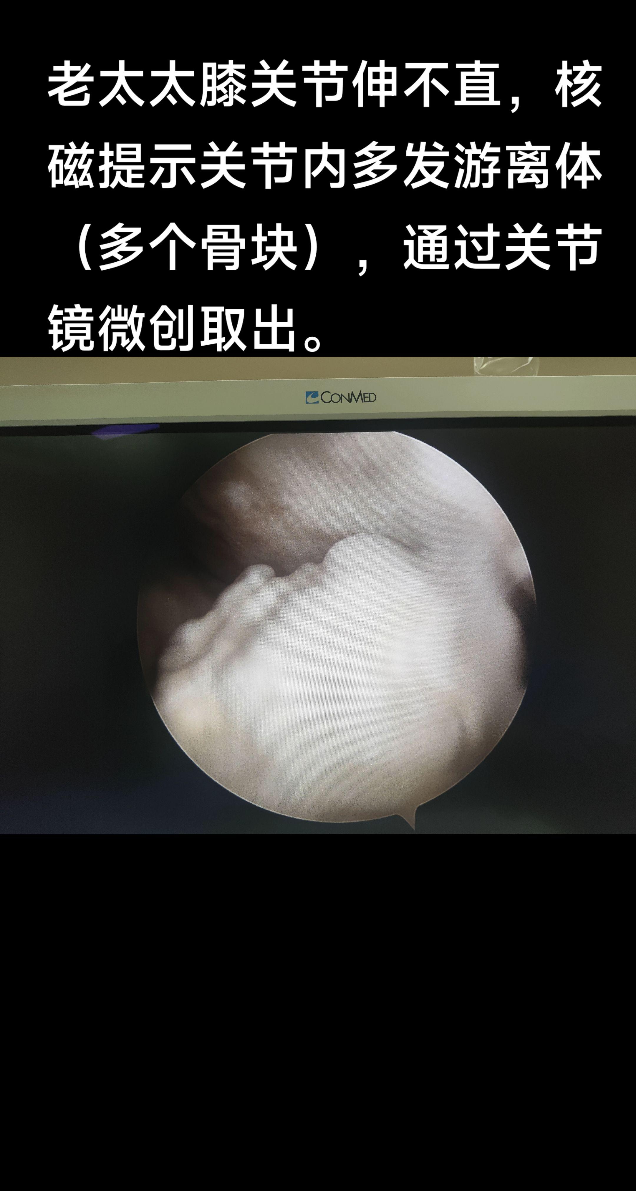 膝关节里长骨头。