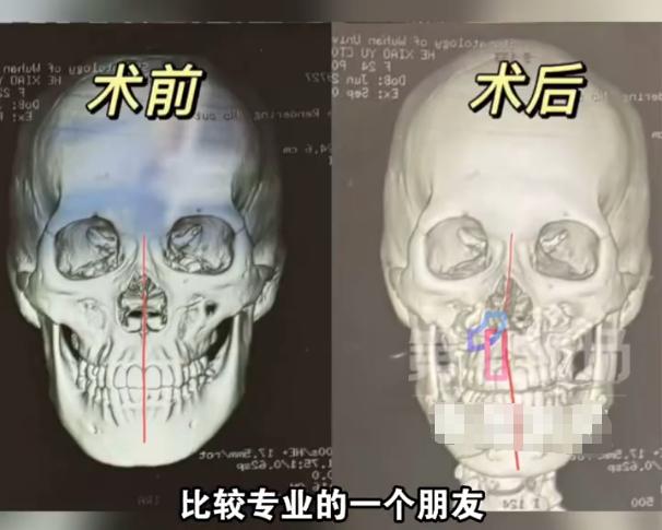 “鞋拔子脸是基本正常？”7月24日，上海一家民营医院里，24岁姑娘本想告别地包天