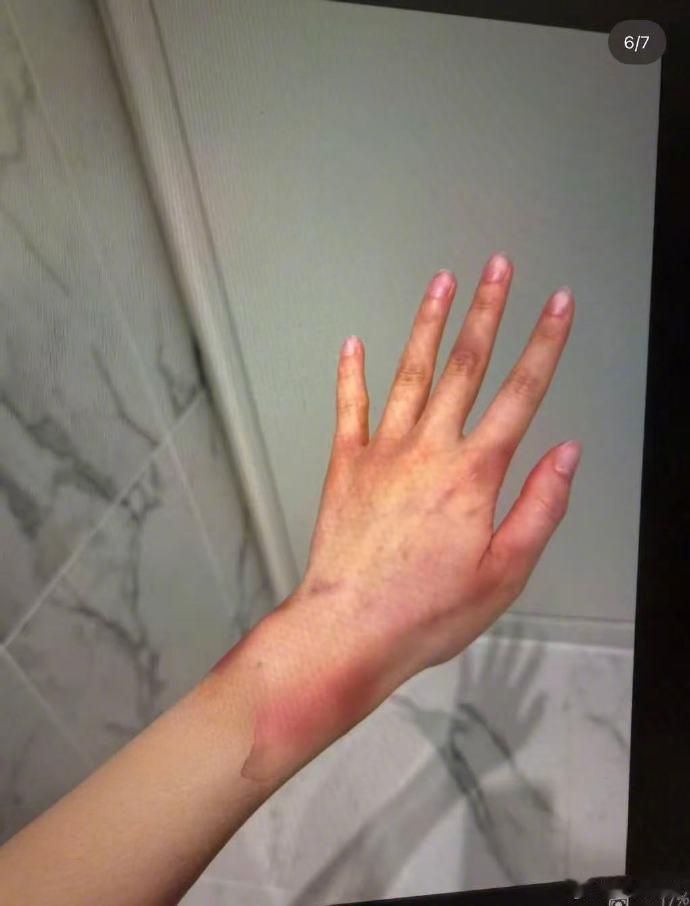 【jisoo哥哥被曝家暴】疑似jisoo嫂子晒家暴伤痕18日，韩网爆料疑似金智秀