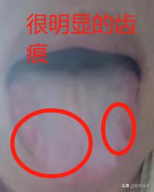 朋友，你的舌头都瘀成这样了，还一个劲的去补肾，医生给你个忠告，赶紧清瘀血吧

主