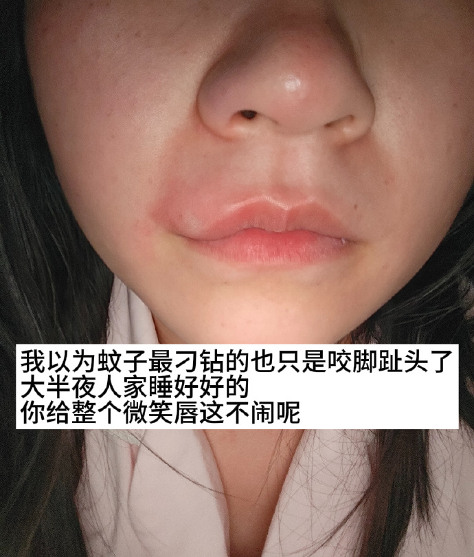 论蚊子咬人有多刁钻 