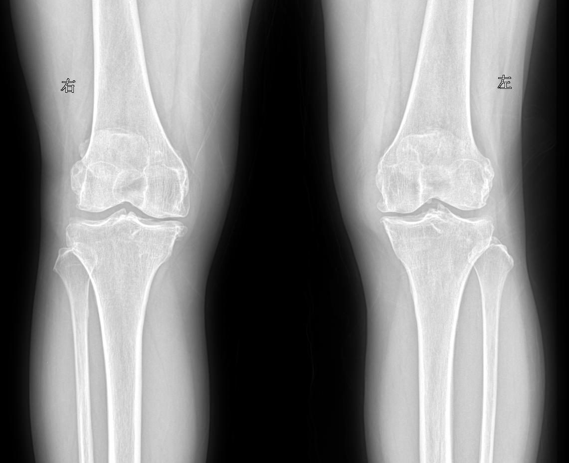 患者女 74岁行走时膝关节疼痛就诊