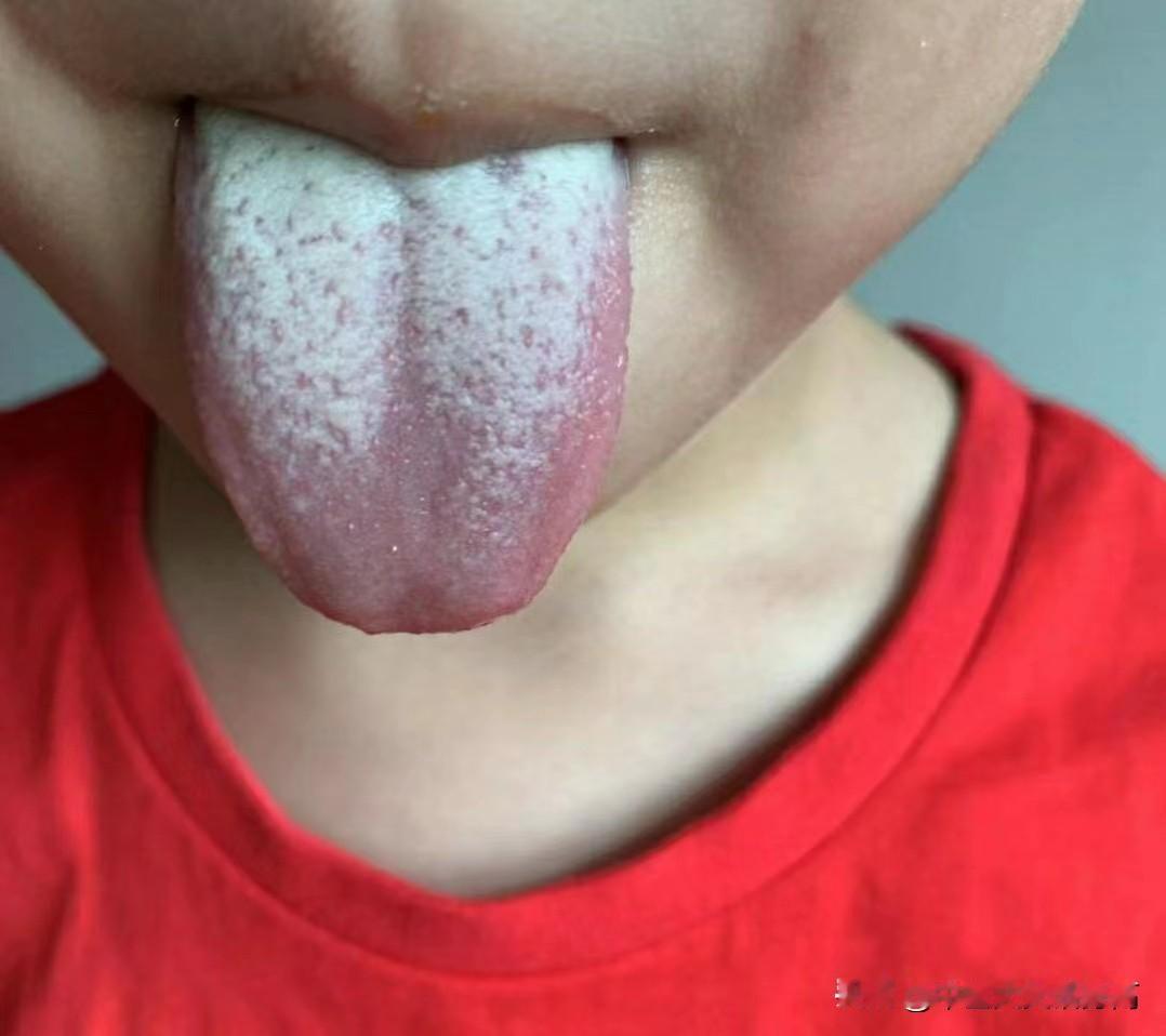 孩子积食发展的4个阶段，对照一下你家处于哪个阶段？
 
1. 积食初期
当孩子吃