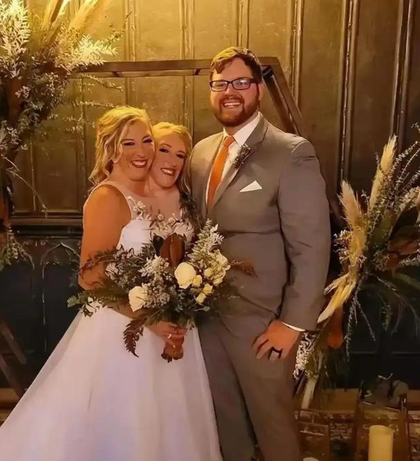 美国一对连体双头姐妹，姐姐结婚，妹妹仍单身。两人共用一具身体、肝脏与下半身器官，