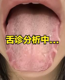 这种舌头，肝郁没有10年，也得5年以上了，舌头都有裂纹了，下一步就是结节、囊肿找