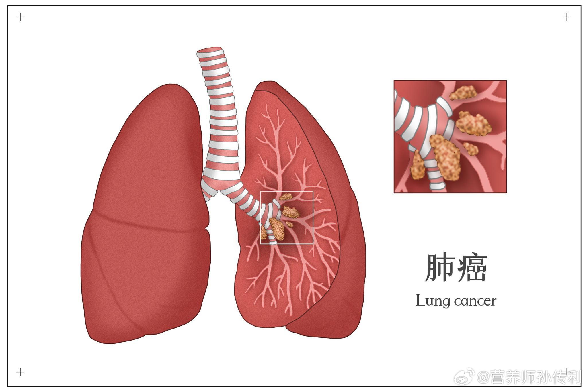 #健康食验计划# 【肺癌的危险因素有哪些？】吸烟（包括二手烟甚至三手烟）、空气污