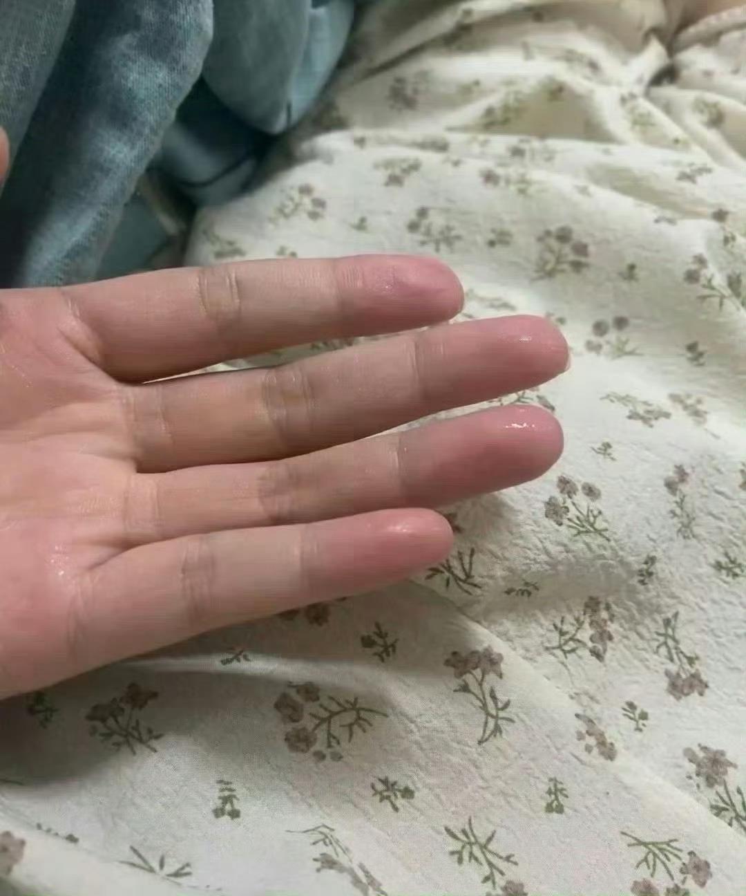 夏天你们的手也容易出汗吗？ ​​​[钢铁侠]  ​​​