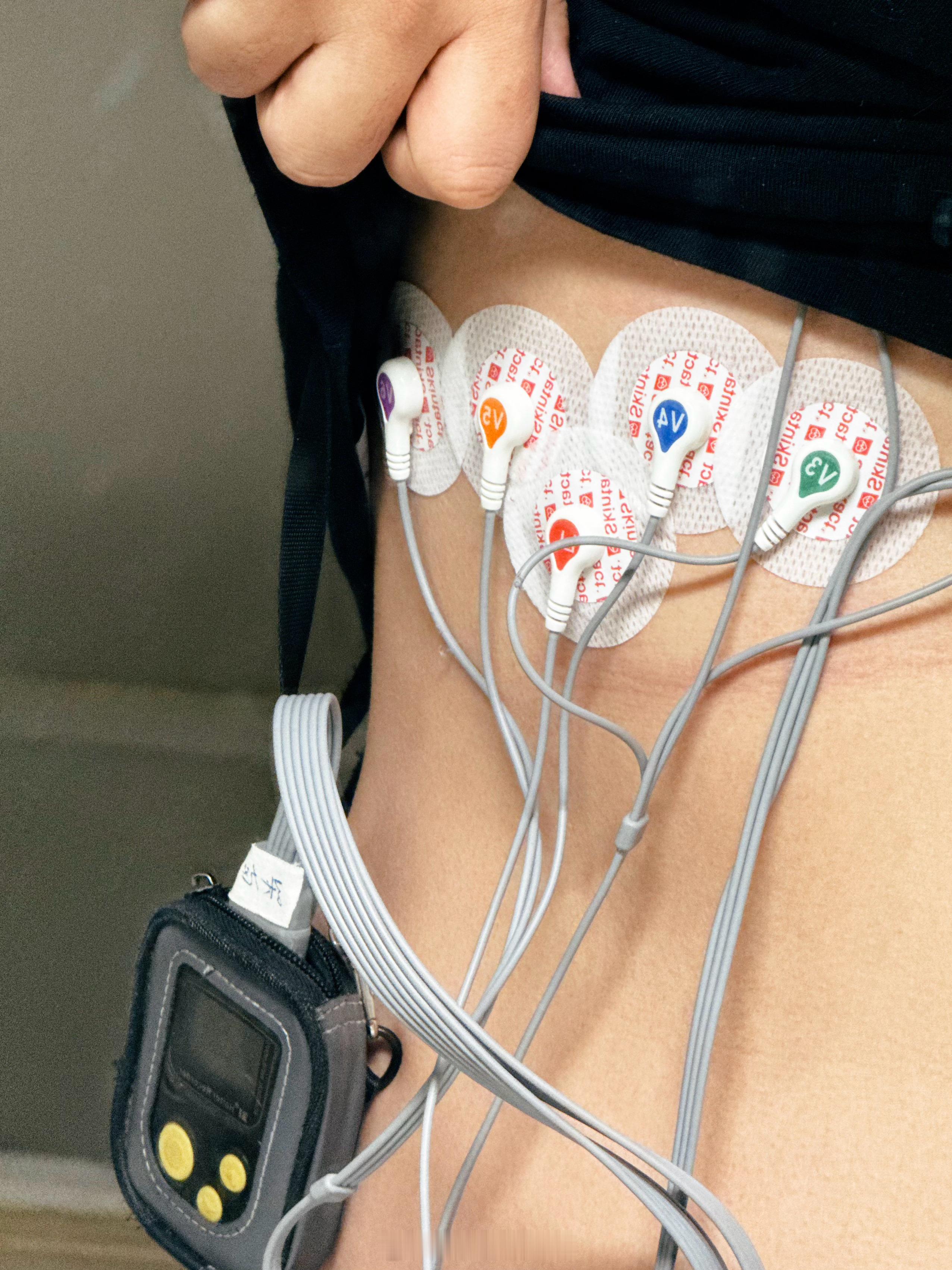 Holter 背上了…但是这次贴的位置和上次位置咋不一样啊，这次全集中在了一个位