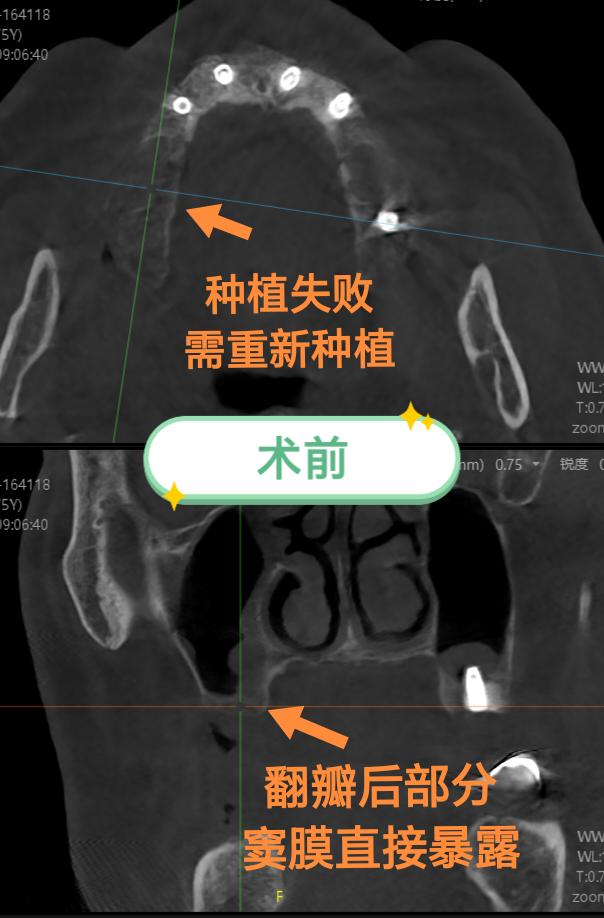 外院提升植骨失败，再次外提植骨。外院即刻负重病例，估计上颌窦提升时窦膜...