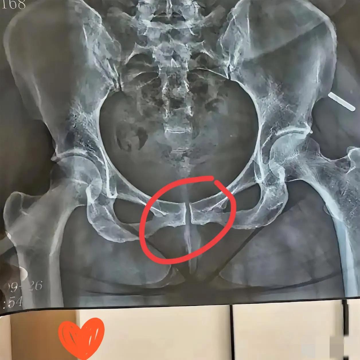 儿子突然举着张片子凑过来，一脸严肃问我“妈妈，你骨头断了吗？”，当时我愣了一下，