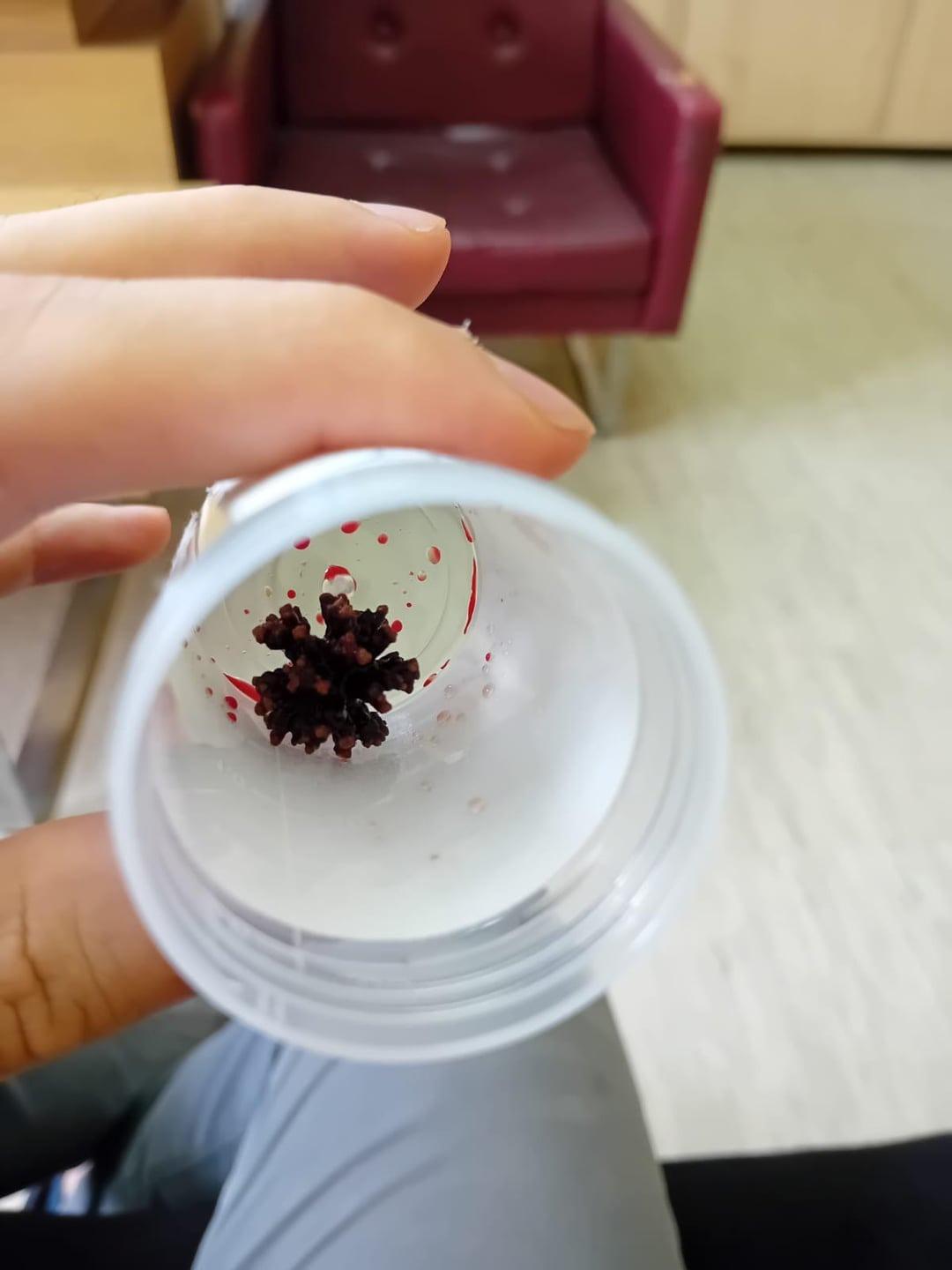 国外网友晒出了自己体内取出的肾结石，发现长得非常像新冠病毒，看着就觉得疼…(图1