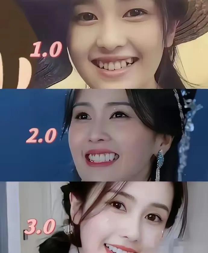 美齿进化史，当年的龅牙，经过几轮修复，一眨眼就变成了整齐的美牙，是不是很神奇？