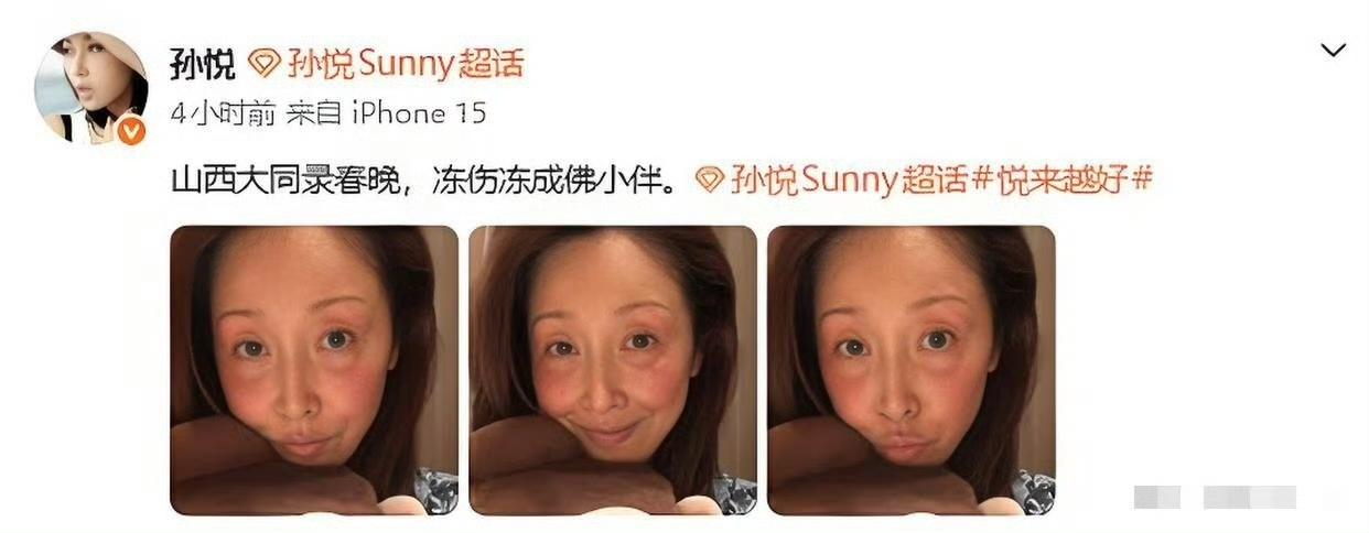 孙悦是真拼了！寒冬腊月录春晚，孙悦在零下20摄氏度的大同室外录制时，脸颊和眼圈都