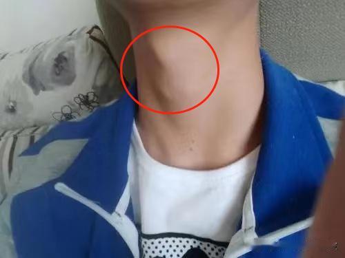 10岁男孩喉结增大，已进入变声期，再不追高就晚了！

我接诊的一个10岁男孩，身