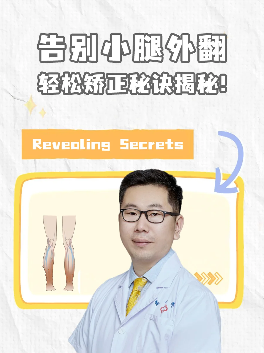 小腿外翻怎么矫正