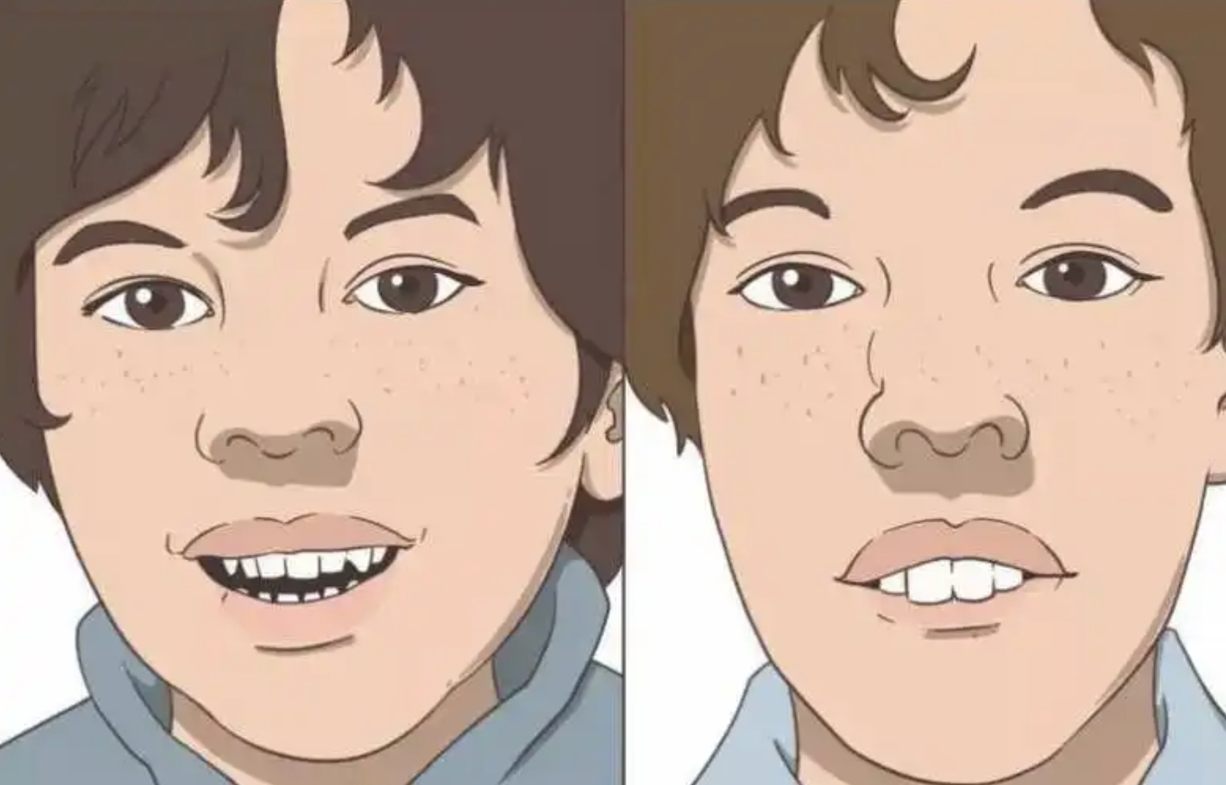  长期口呼吸会影响孩子颜值、也会引发牙齿、咽部、口腔等问题。如果家长怀疑宝宝有这