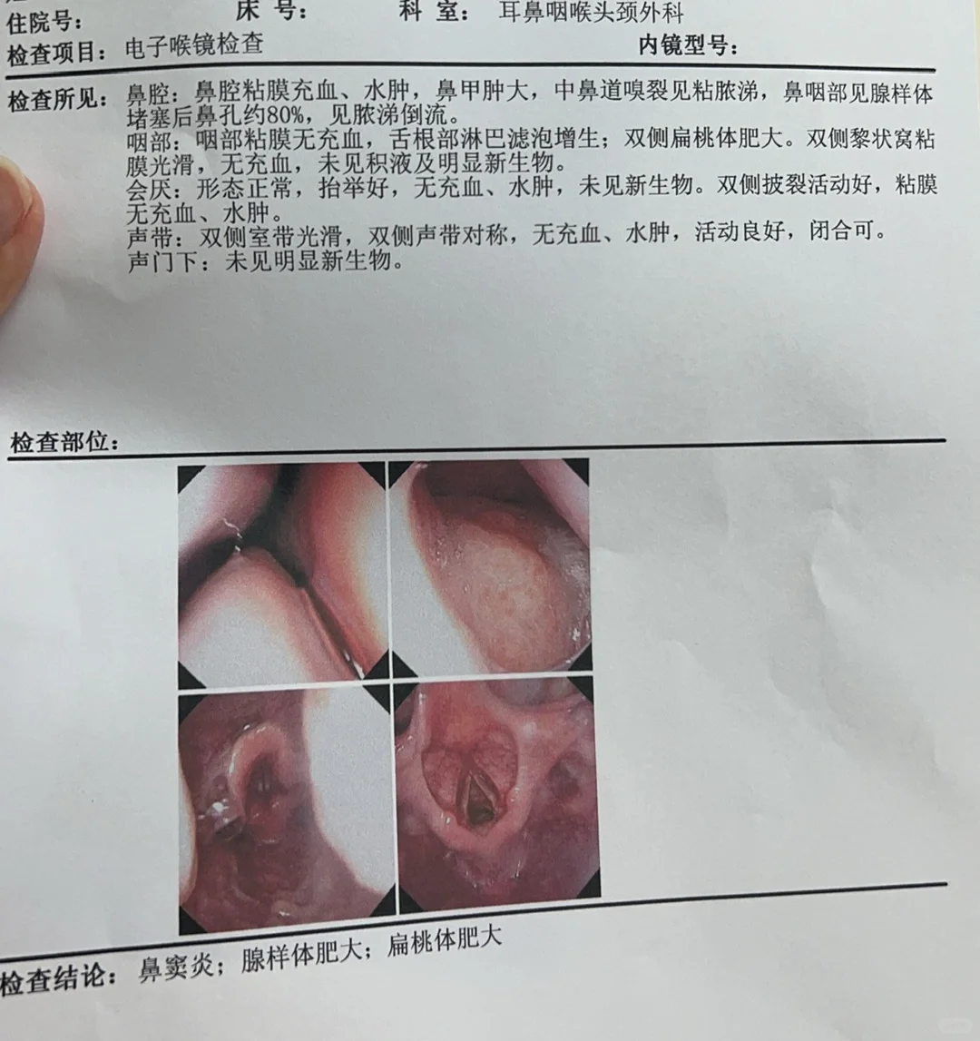 老公，今天带儿子去做了喉镜检查，腺样体堵了80%，准备安排他做手术了 ...