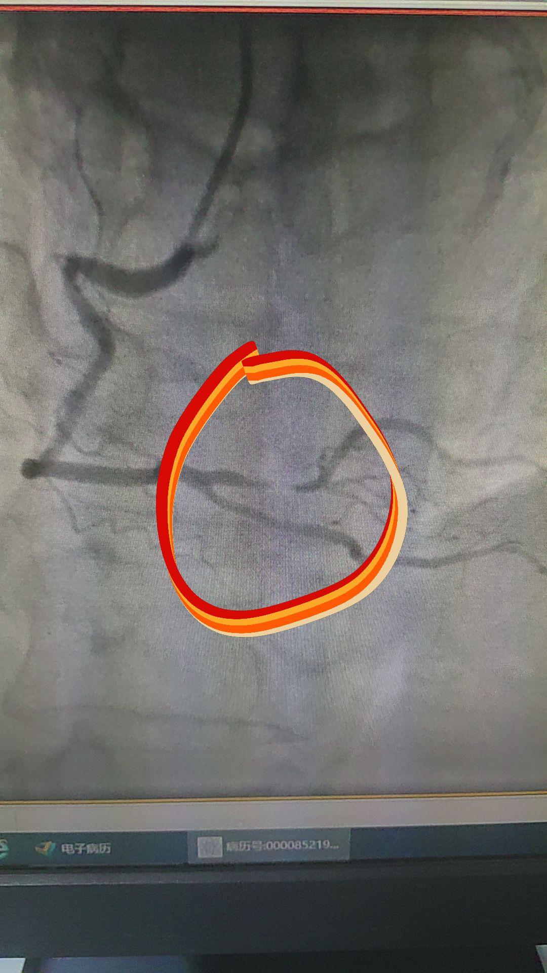 一根小小的血管狭窄，就整得人胸痛出汗！这就是心梗！
