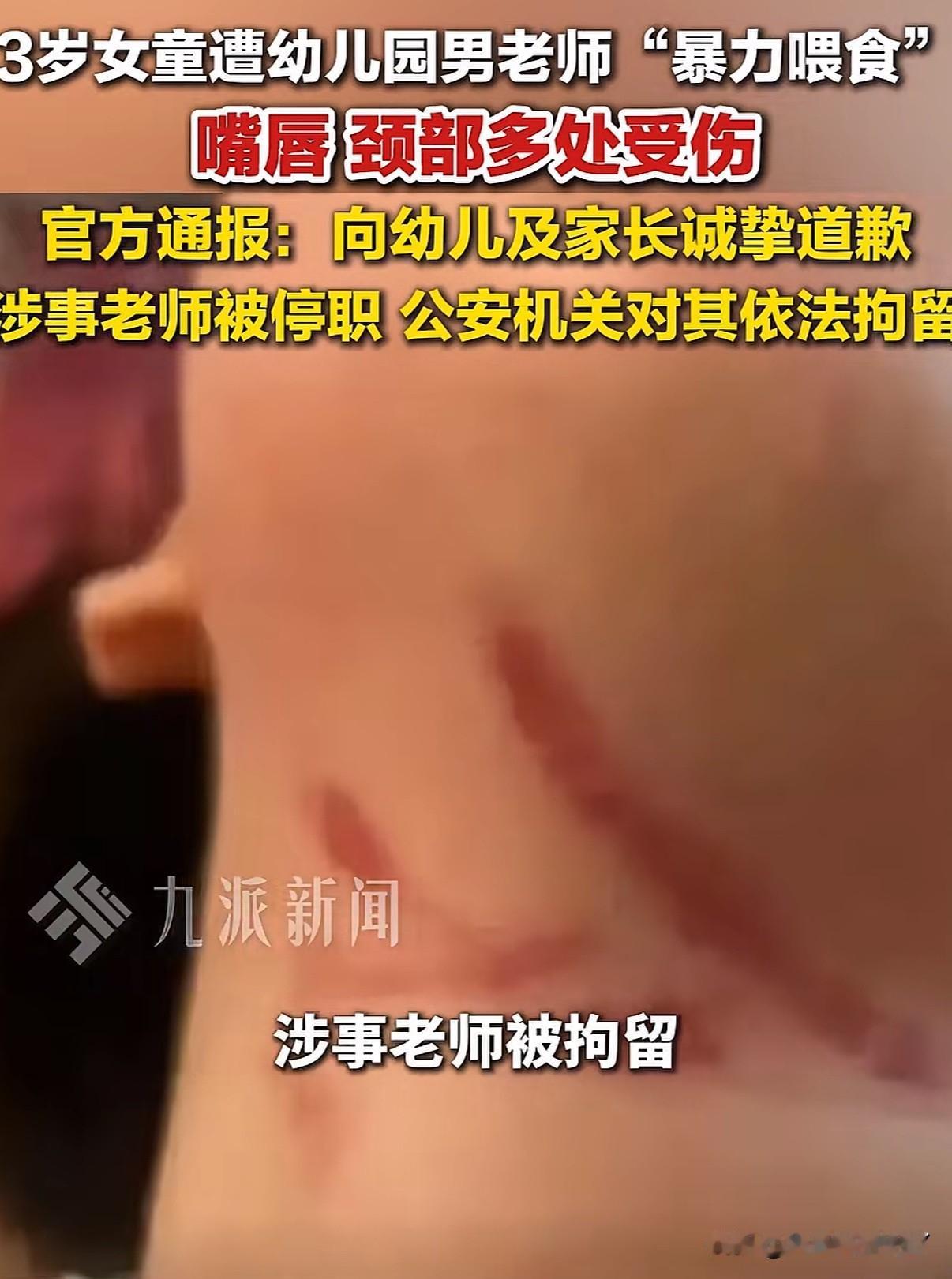 可恶！广东一3岁女童幼儿园遭男老师强行喂食。嘴唇、脖颈处留下多处撕裂疤痕

20