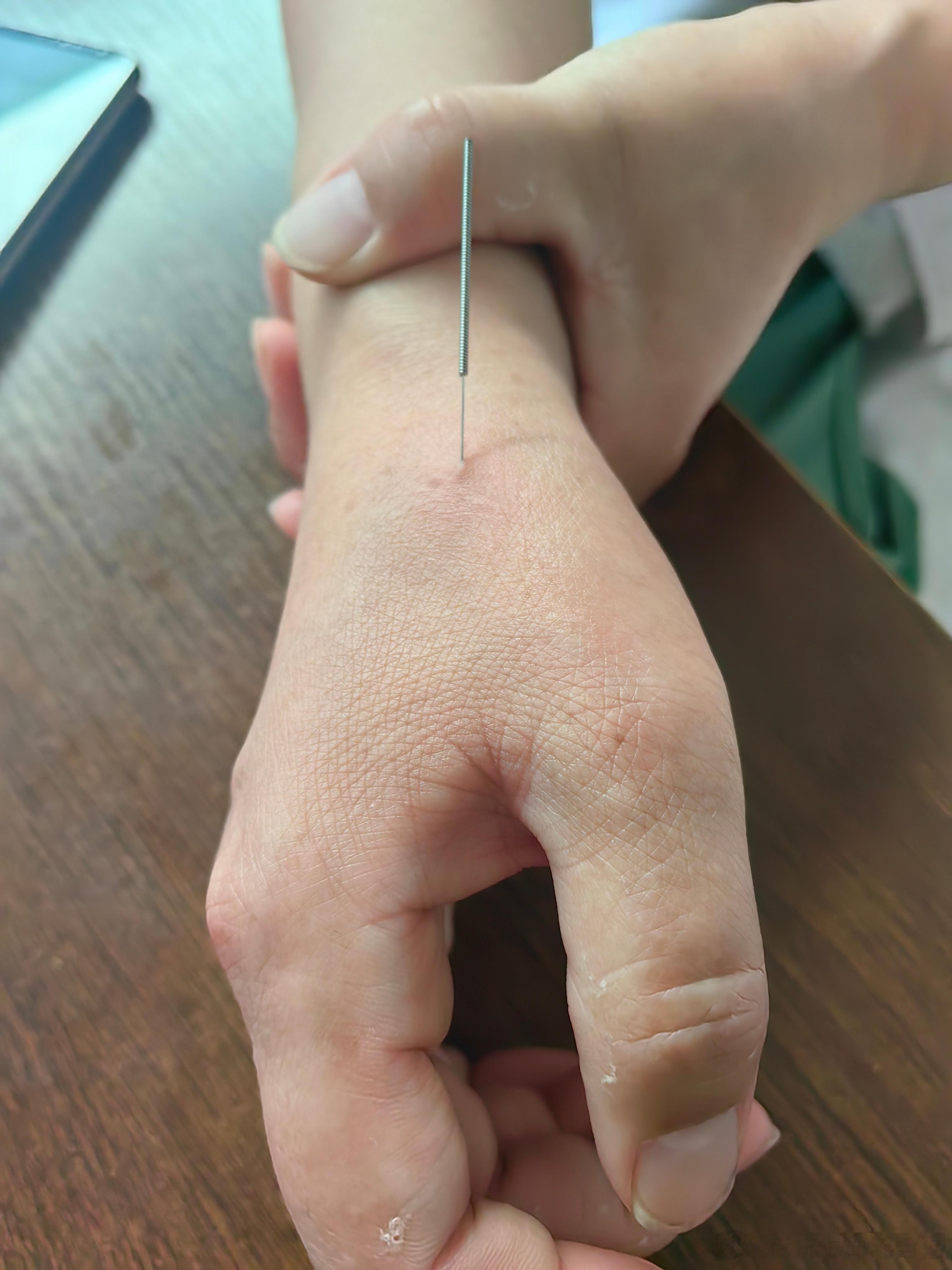 针灸治疗腱鞘炎 ​​​