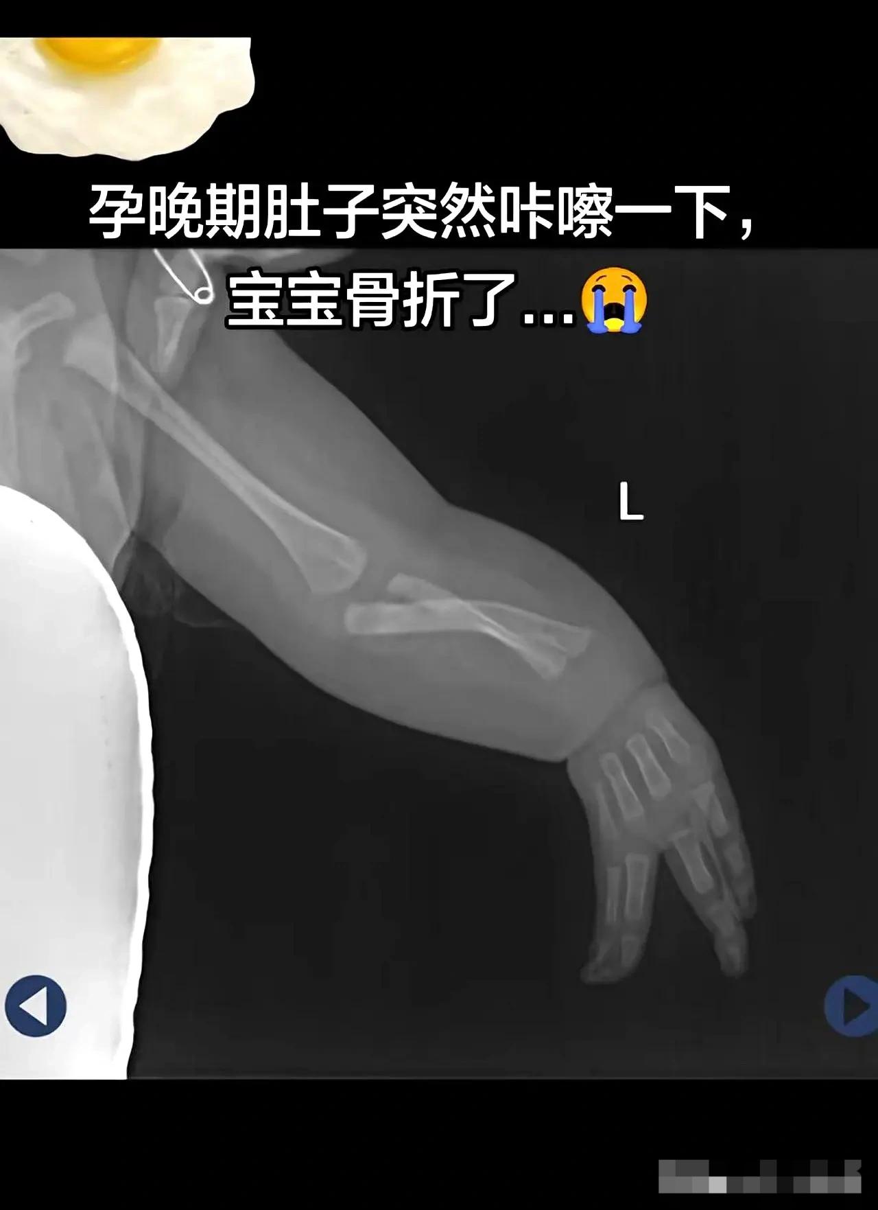 一夜无眠，半夜醒来，肚子里传来“咔嚓”声把我惊醒了，睡意全无。
原以为是我睡姿太