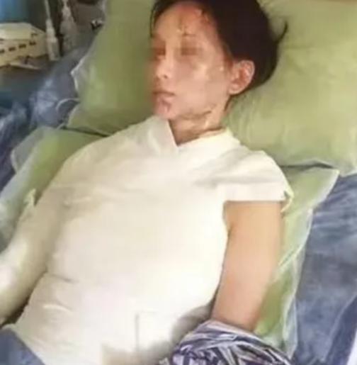 "这就是嘴欠的下场"！一盆滚烫高汤从头顶浇下，28 岁温州姑娘林某的面容瞬间被高