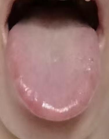 宗筋敏感切莫依赖外用麻痹，聊聊其中弊端






不少年轻粉丝受到敏感度偏高的