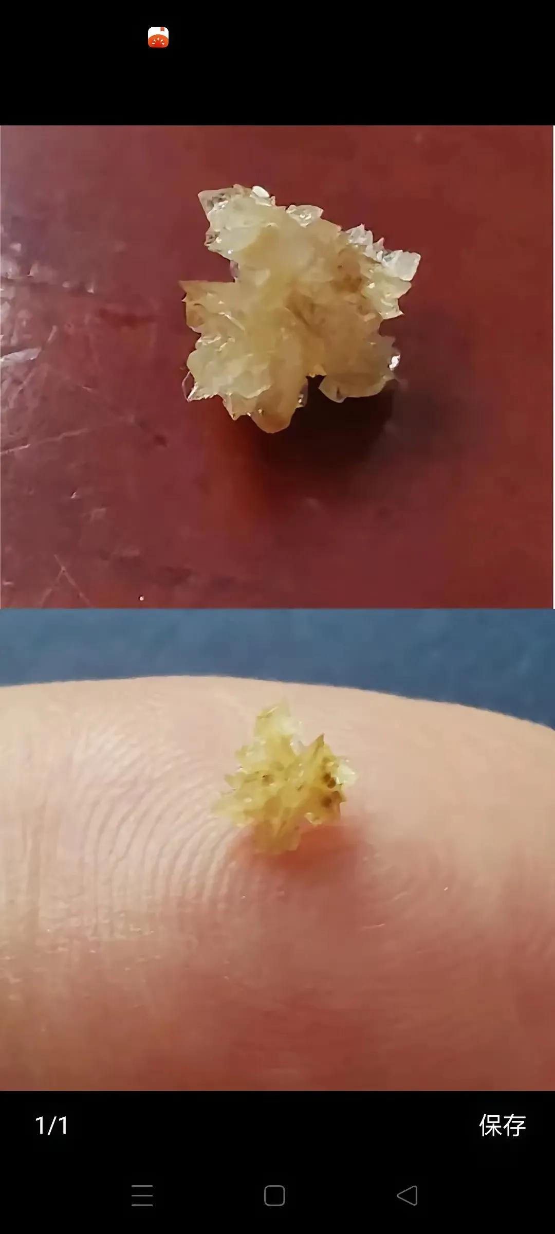 看到一位网友排出肾结石真是太幸福了，我也有肾结石快20年了，一直没排出来，这些年